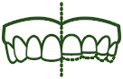 Cause of Tooth Sensitivity - Attrition