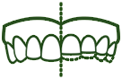 Cause of Tooth Sensitivity - Bruxism