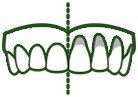 Cause of Tooth Sensitivity - Gingival Recession